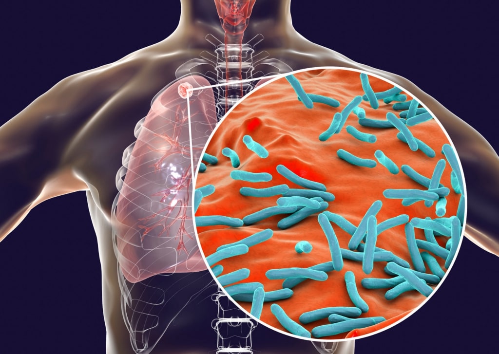 Фтизиатр: Туберкулез влияет на сердце и сосудыForPost - Здоровье